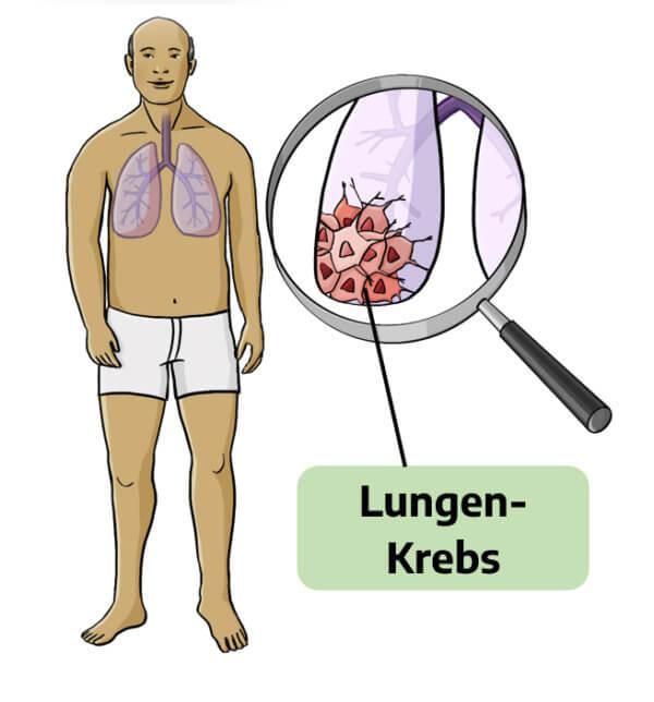 Krebs erklärt Krebsgesellschaft NRW e V